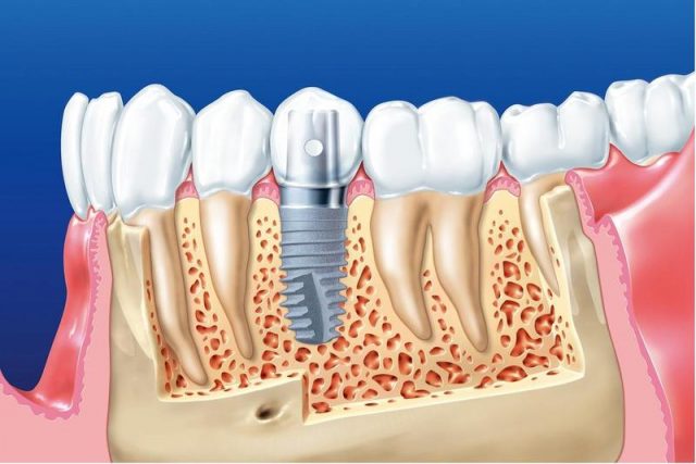 trồng răng giả bằng phương pháp cấy implant