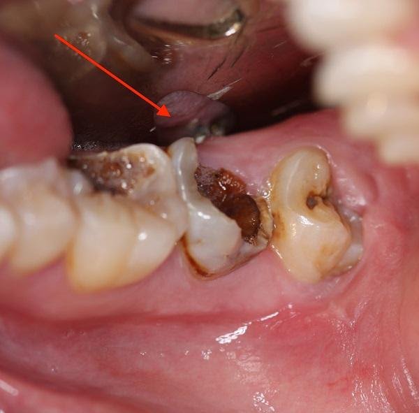 răng sâu vỡ lớn cần phải điều trị tuỷ tại đà nẵng