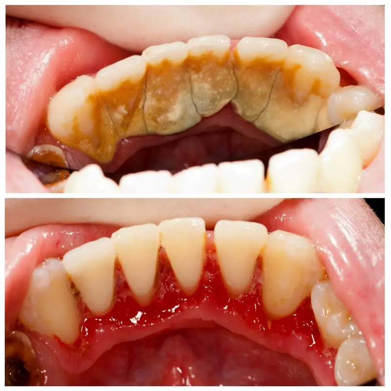 hình ảnh trước và sau khi lấy cao răng