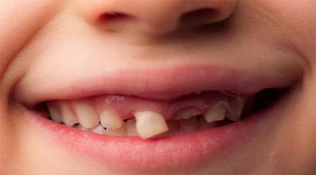 Răng sữa mọc lệch sai vị trí mọc. Đối với nguyên nhân này, trẻ em khi thay răng có thể sẽ không còn hiện tượng mọc thưa.