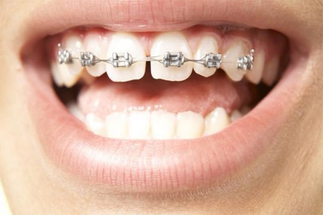 Niềng răng kéo để các răng khít và khít với nhau sẽ mất khoảng 1 đến 2 năm điều trị. Tuy nhiên, đối với niềng răng thưa thì điều này còn phụ thuộc vào nhiều yếu tố. Có thể kể đến như: độ tuổi của người niềng răng, mức độ thưa của răng cũng như tình trạng răng miệng. Theo nhiều chuyên gia, độ tuổi niềng răng dễ dàng và nhanh chóng nhất là lứa tuổi thiếu niên (từ 11 – 16 tuổi).