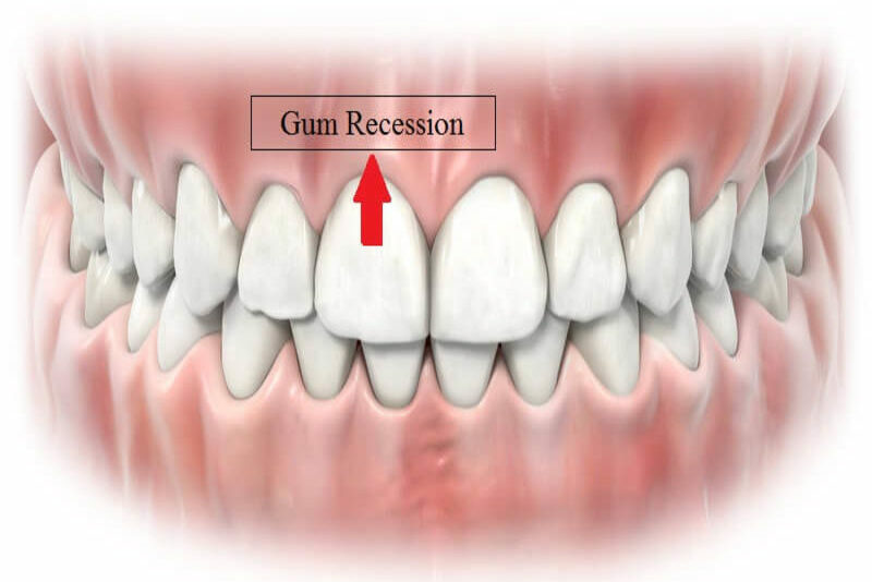 Tình trạng tụt nướu có lẽ không còn quá xa lạ với nhiều người. Bệnh nướu răng này không chỉ gây mất thẩm mỹ mà còn gây ra những ảnh hưởng xấu cho răng miệng. Hãy cùng nha khoa Dana tìm hiểu tụt lợi là gì? Và giải pháp trong trường hợp lợi bị hở.