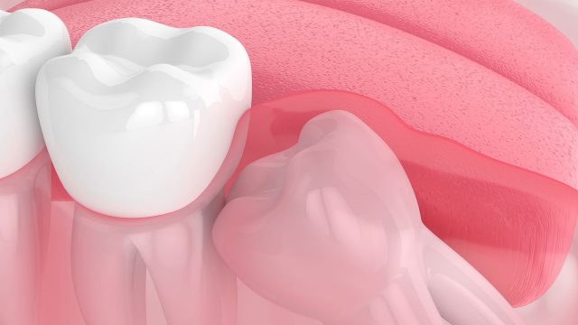 Chúng ta thường biết răng khôn sẽ mọc ở độ tuổi từ 16-18. Nhưng thực ra đây là khi bạn thấy răng khôn nhú lên khỏi nướu. Từ 10 tuổi, răng khôn bắt đầu hình thành ở góc xương hàm. Sau đó, chúng sẽ tiếp tục phát triển dần dần. Mỗi người có một thời điểm mọc răng khôn khác nhau. Có người chỉ mất vài tháng nhưng cũng có người phải mất hàng năm trời để mọc răng khôn.