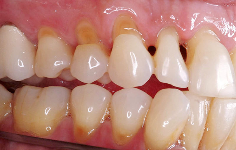 Trám kẽ răng thưa: Đối với những người có nhược điểm là răng mọc thưa tạo nên những khoảng trống lớn. Trám răng có tác dụng tạo một miếng đệm để thu hẹp khoảng trống giữa các răng, trả lại hàm răng đều đẹp. Trám răng: Trước vấn đề răng bị sứt mẻ thì hàn trám là một trong những phương pháp có thể áp dụng để phục hồi thẩm mỹ. cho răng.