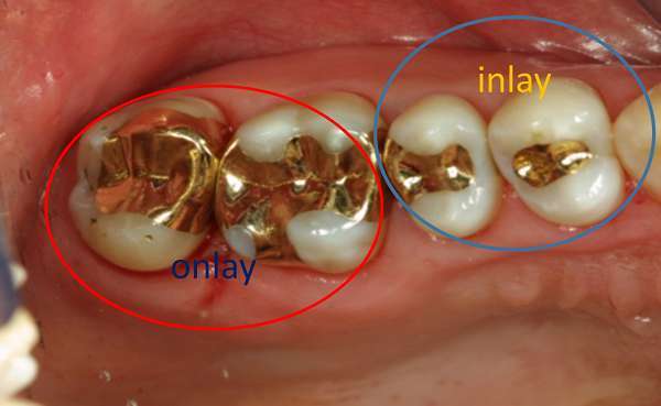 Trám răng Inlay, Onlay là gì? Có tốt hơn so với trám thông thường?
