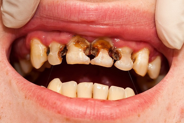 răng bị đen do sâu răng