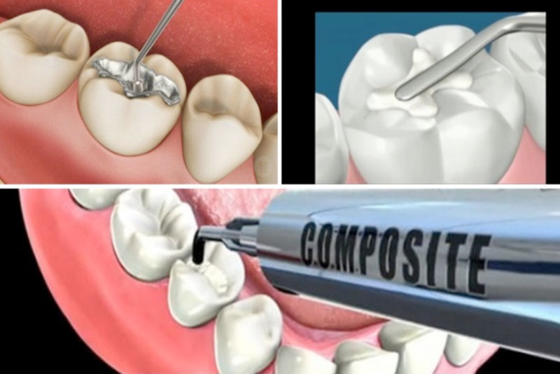 Khi vùng răng bị sâu đã được làm sạch, bác sĩ sẽ tiến hành quy trình trám răng thẩm mỹ để che lấp lỗ răng bị sâu theo từng thao tác sau: Bôi dung dịch axit nhẹ lên phần răng cần phục hình (Etching). Phủ một lớp keo tạo độ kết dính (Bonding). Photopolyme hóa cho liên kết khô. Vật liệu composite sẽ được trám thành từng lớp mỏng (nhiều hay ít tùy thuộc vào từng răng), bác sĩ sẽ điêu khắc miếng trám theo hình dáng của răng. Chiếu đèn quang trùng hợp để Composite và răng tạo thành một khối đồng nhất. Kiểm tra xem khách hàng có khó chịu với miếng trám hay kẹo cao su không thì tiến hành mài và điều chỉnh. Làm nhẵn bề mặt và đánh bóng miếng trám để giữ chất trám vào răng.