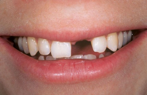 Người bị tiêu xương do hậu quả của việc nhổ răng