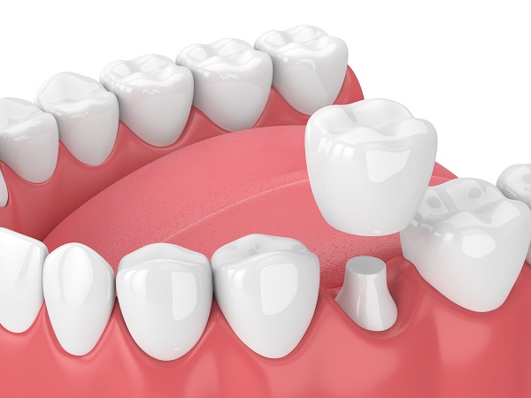 Bọc răng sứ để bảo vệ cấu trúc răng