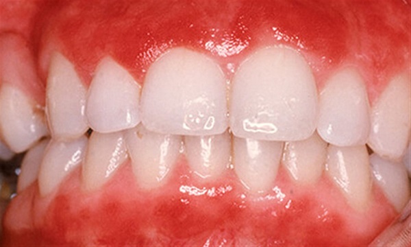 Bọc răng sứ khắc phục tình trạng hở nướu