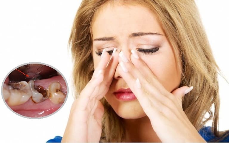 Viêm xoang là nguyên nhân gây đau răng về đêm 