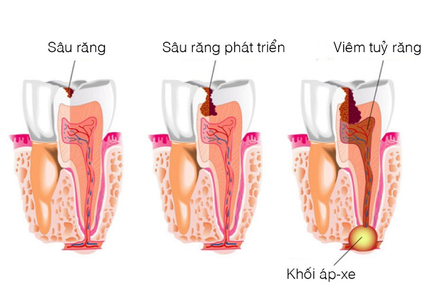 Dấu hiệu áp xe răng là gì?