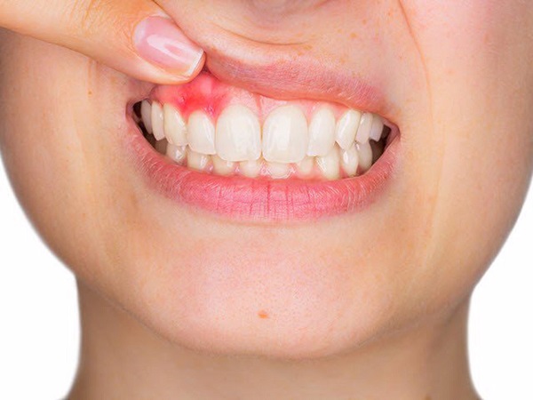 Bị sưng nướu sau khi bọc răng sứ có nguy hiểm không?
