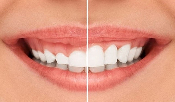 Cắt lợi (nướu) có đau không? Có nguy hiểm gì không?
