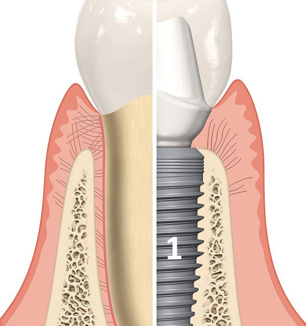 Các thành phần cấu tạo nên một răng Implant hoàn chỉnh