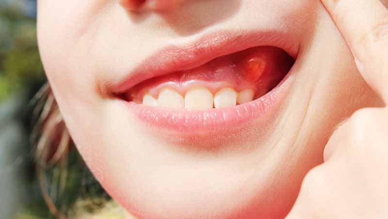 Nguyên nhân và cách điều trị chảy mủ chân răng