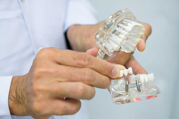 Chi phí trồng răng implant có đắt không?