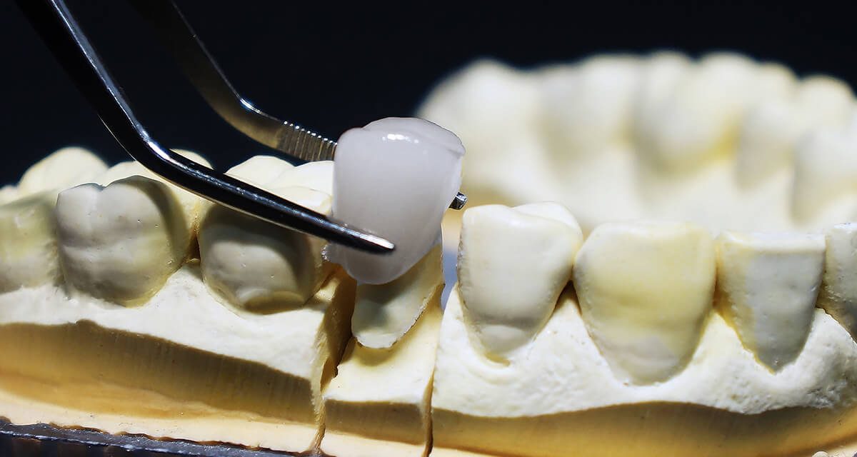 Bị sâu răng có nên bọc răng sứ hay không?