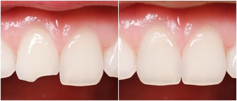 Công nghệ nào được sử dụng để trám răng?