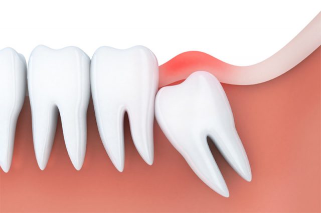 Răng khôn là vị trí răng dễ ảnh hưởng đến cung hàm