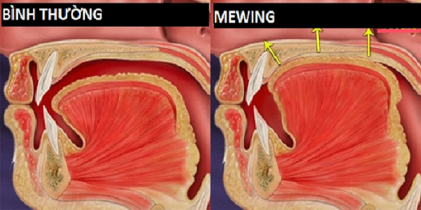 Mewing là gì? Tác dụng và Cách tập cho đúng