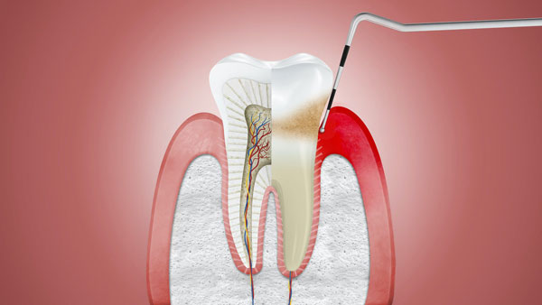 Viêm nướu, viêm lợi là gì? Cách điều trị