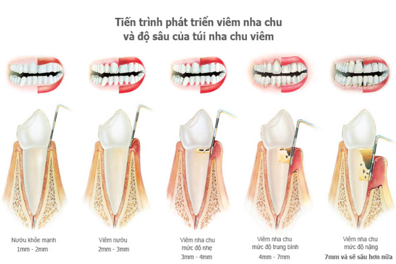 Những cách chữa viêm nha chu hiệu quả nhất