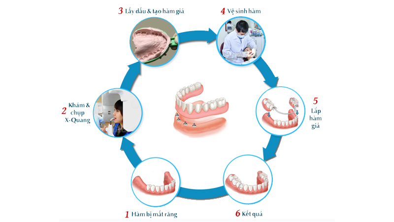 Quy trình trồng răng giả tháo lắp mất bao lâu?