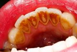 Răng bị đen bên trong - Nguyên nhân và cách khắc phục hiệu quả