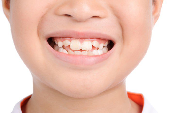 Răng cửa mọc lệch: Nguyên nhân và cách điều trị
