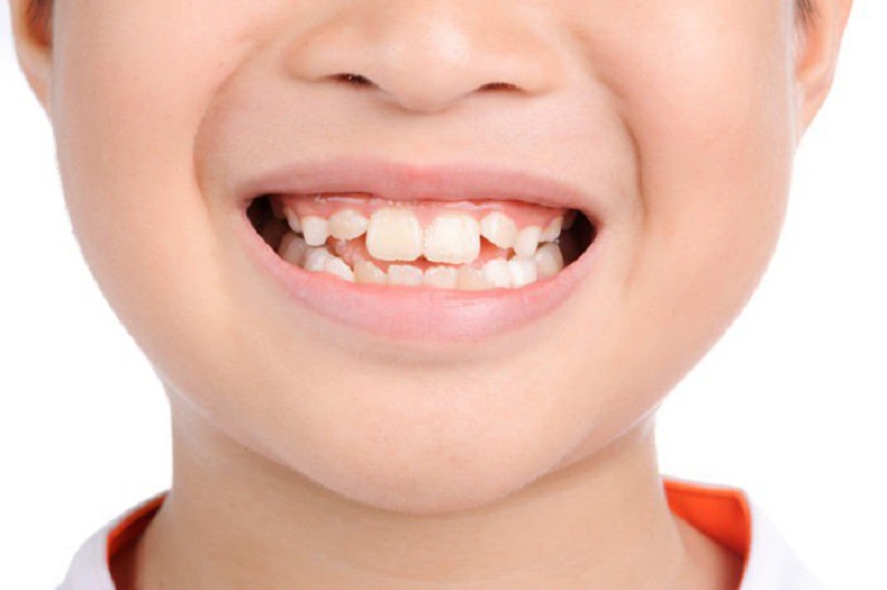 Cách khắc phục răng mọc quá mức ở trẻ