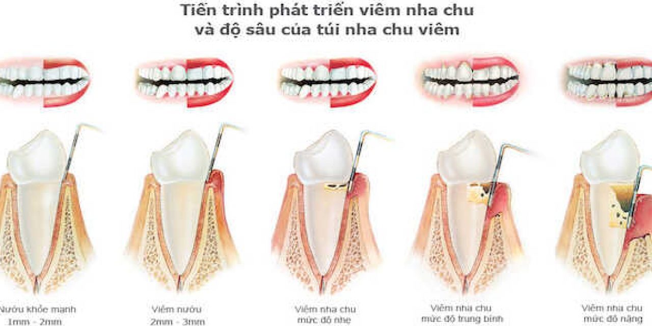 Làm gì khi răng bị viêm nha chu?