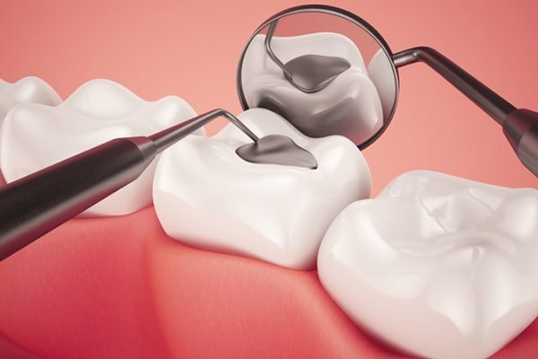Trám răng ở đâu tốt nhất tại Đà Nẵng?