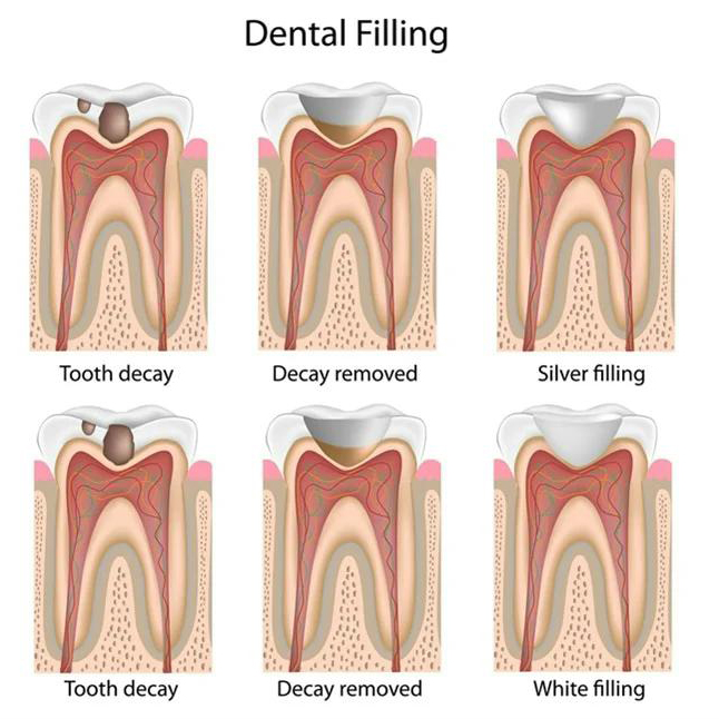 dental fillings in da nang