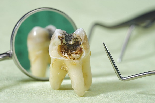 Răng hàm bị hư: Nguyên nhân và cách khắc phục