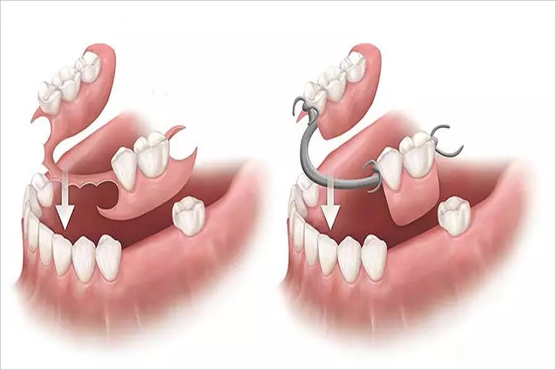 Răng tháo lắp Composite có tốt không?