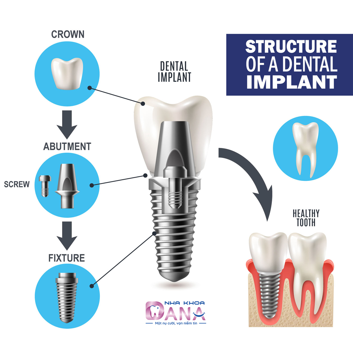 structure dental implant: Dana Dental - implant specalist in Danang