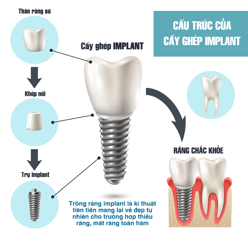 tổng hợp thành phần cấu tạo của một răng implant