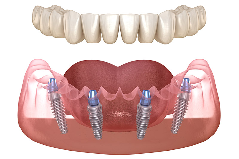 Kỹ thuật trồng răng Implant toàn hàm – All on 4, All on 6