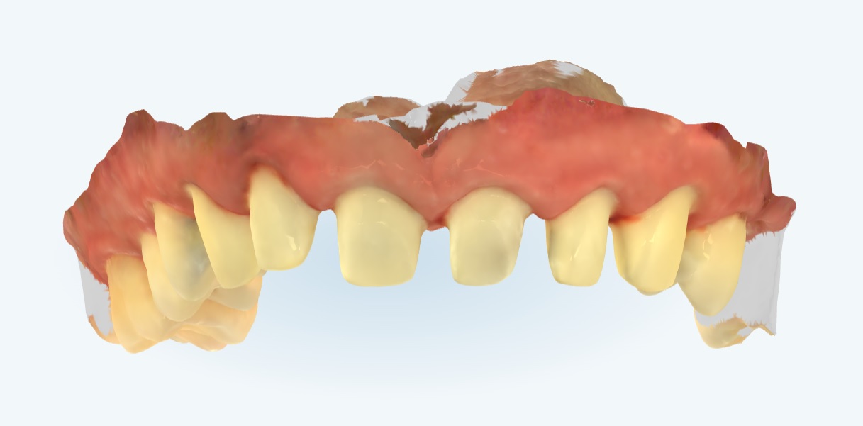 scan 3d by itero for dental crown