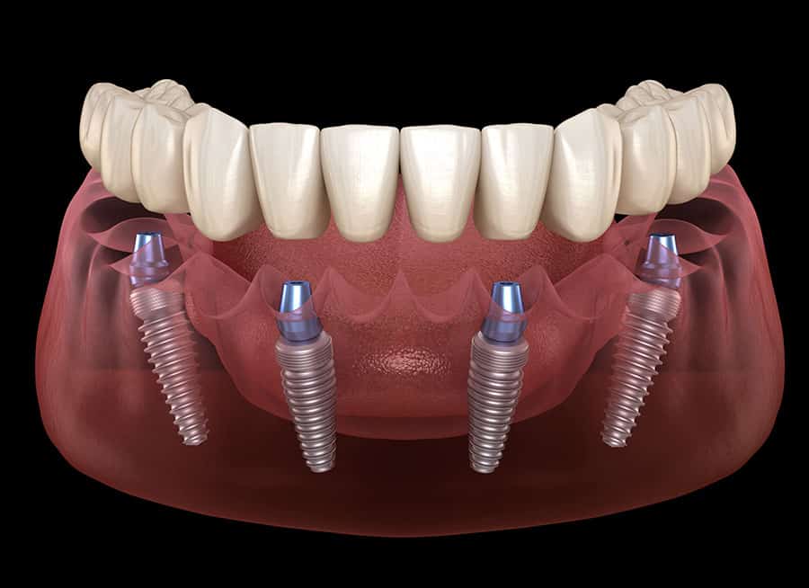 all on 4 dental implant