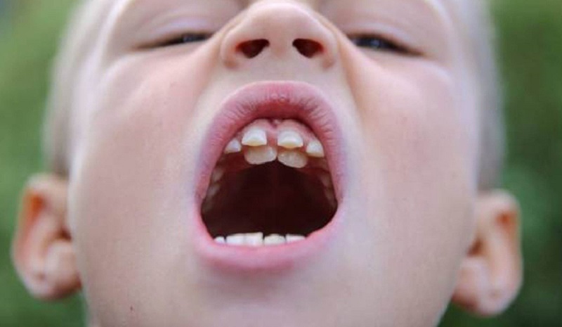 răng mọc lẫy ở trẻ em