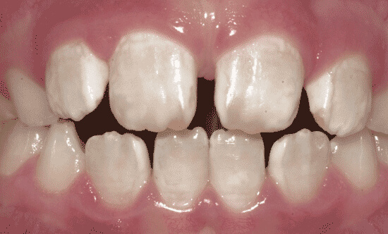 hình ảnh răng nhiễm fluor