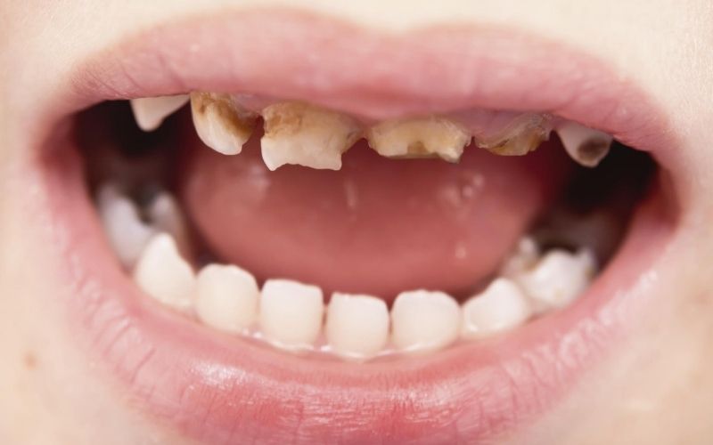 sâu răng sữa toàn hàm