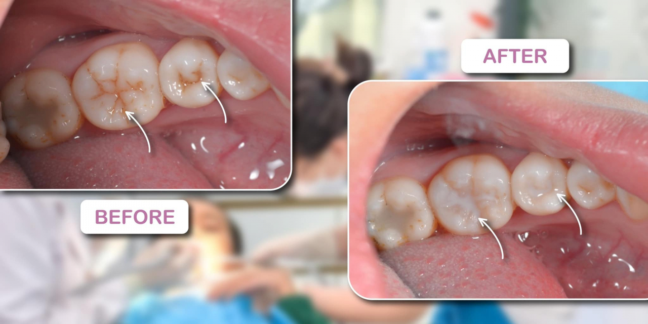 Trám bít hố rãnh (Sealant) giúp phòng ngừa sâu răng hiệu quả