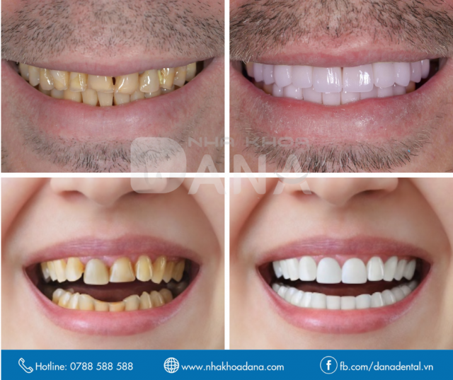 Hình ảnh trước và sau khi bọc răng