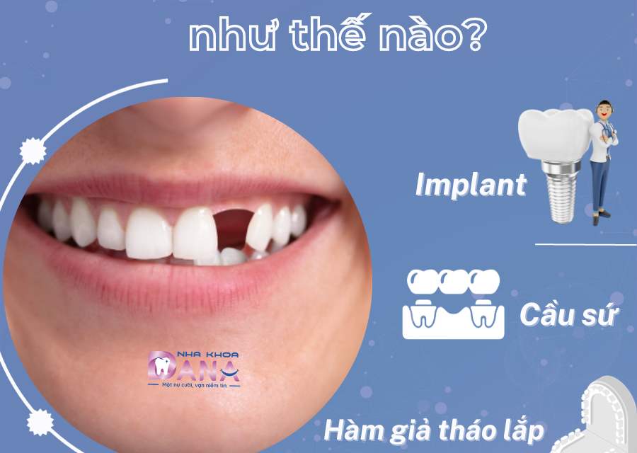 Trồng răng cửa như thế nào và trồng mất bao lâu?