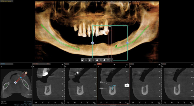 Chụp ct răng trước khi trồng răng implant