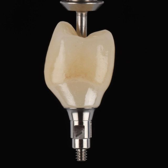 Giai đoạn hoàn thiện: làm mão sứ trên implant